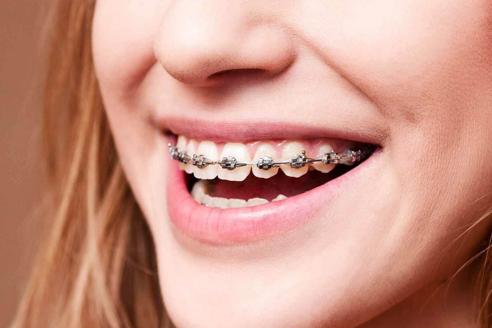 Fixed Metal Braces