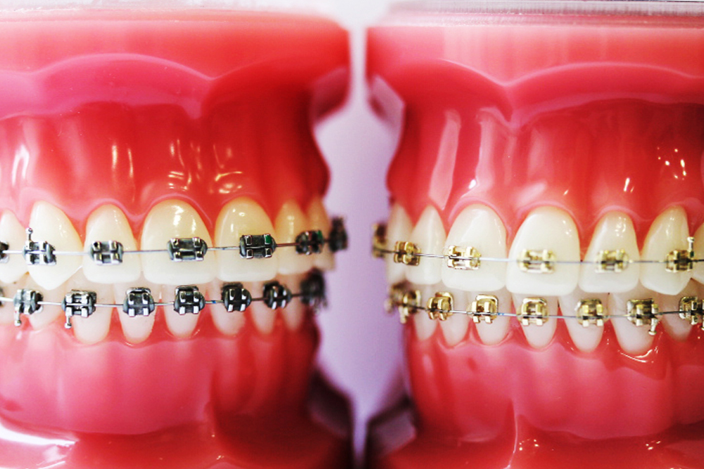 Iconix aesthetic metal braces